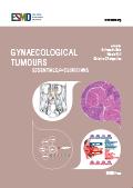 خرید ایبوک Gynaecological Tumours Essentials for Clinicians دانلود کتاب ملزومات تومورهای ژنتیکی برای پزشکان